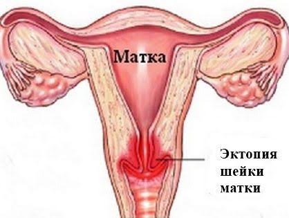 Эрозия (эктопия) шейки матки - Институт здоровья